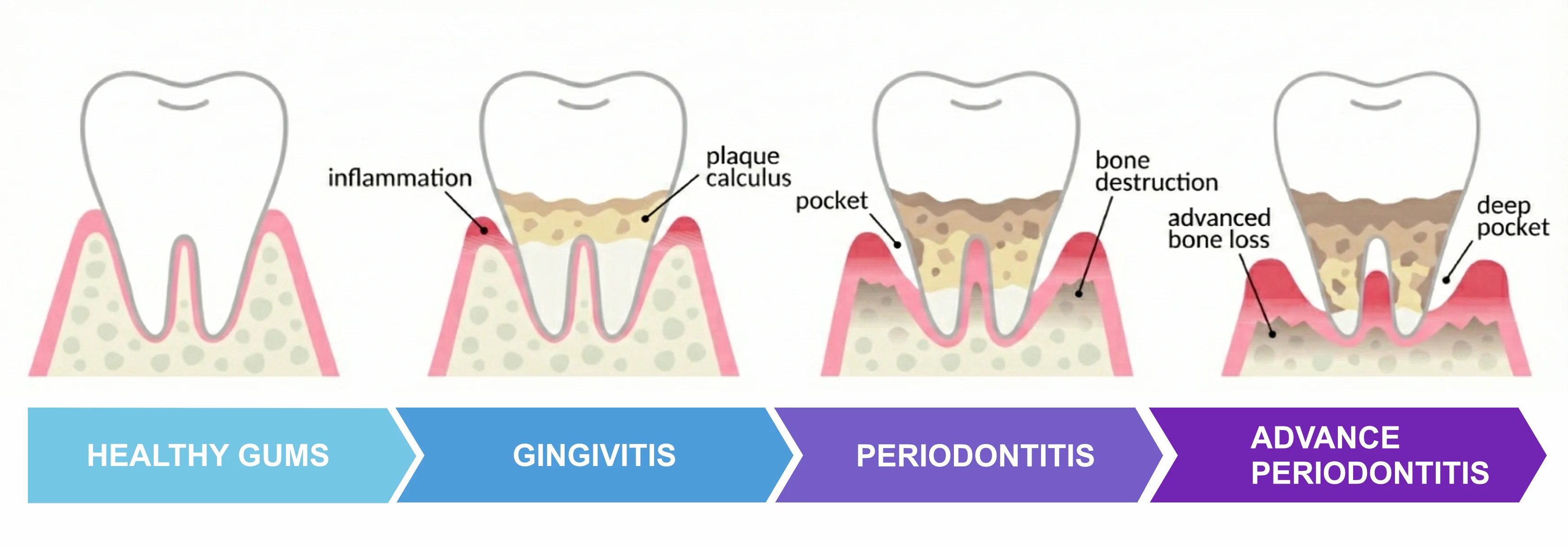periodontal